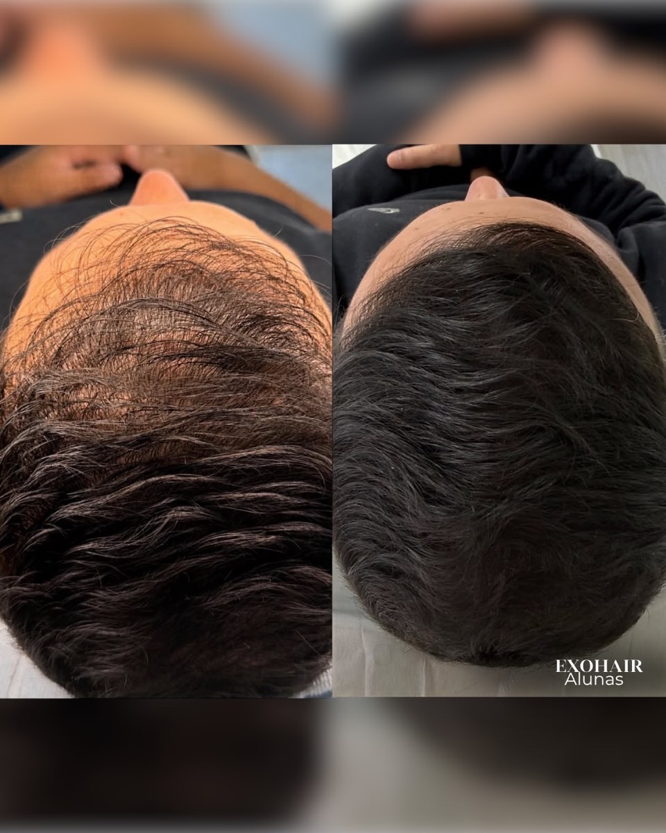 ExoHair, before and after