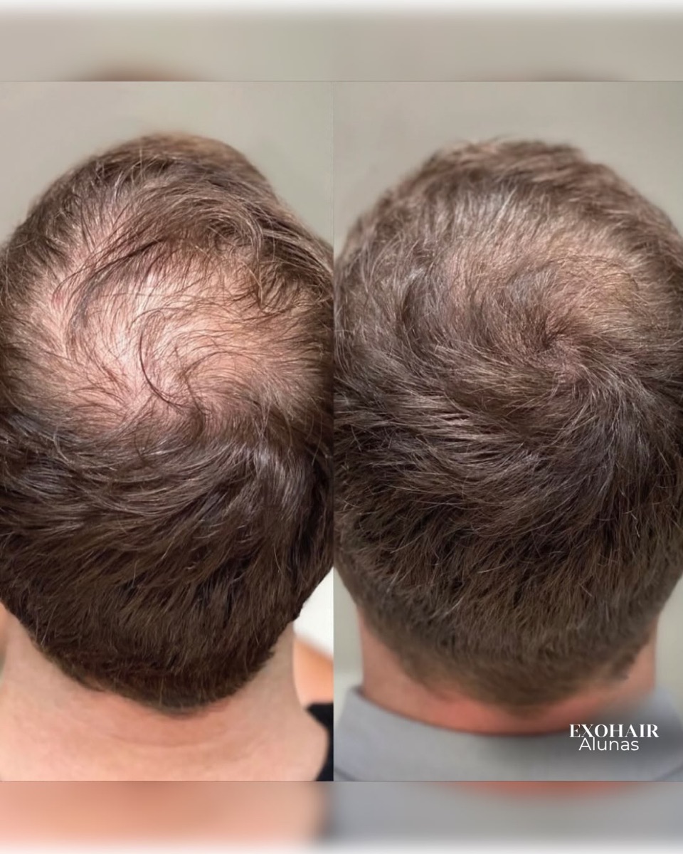 ExoHair, before and after