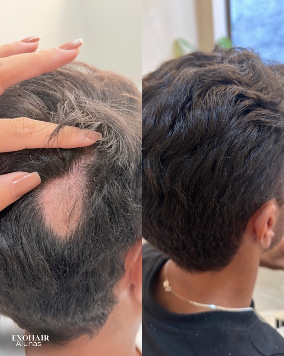 ExoHair, before and after