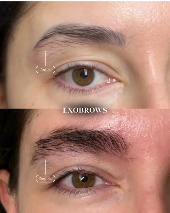 ExoBrows, before and after