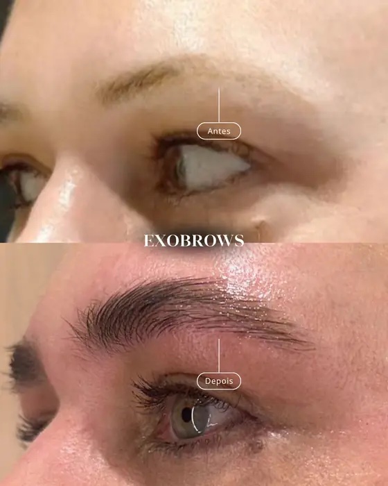 ExoBrows, before and after
