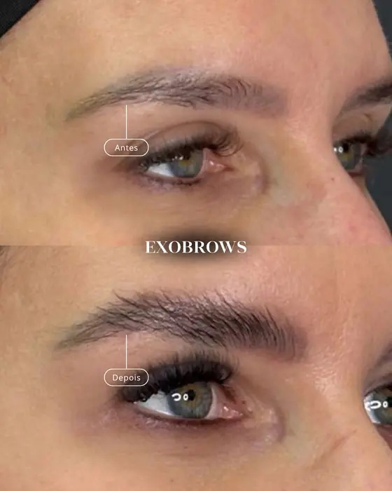 ExoBrows, before and after
