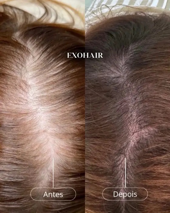 ExoHair, before and after
