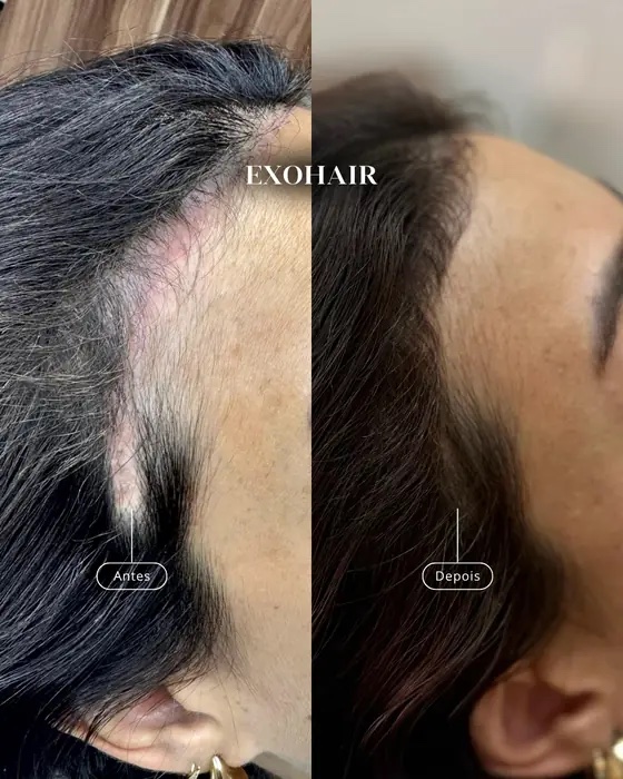 ExoHair, before and after