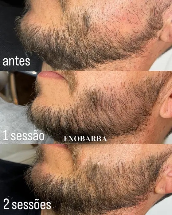 ExoBarba, before and after