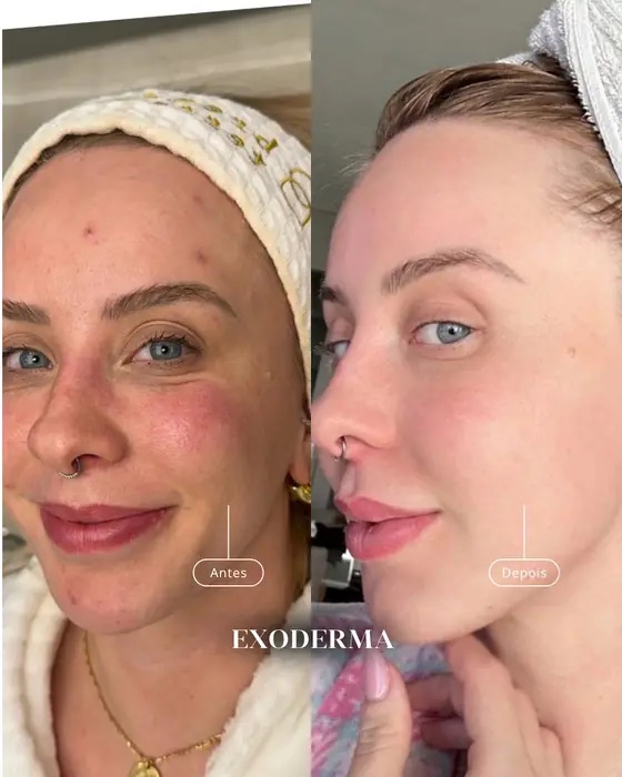Exoderma, before and after