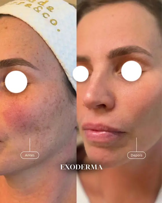 Exoderma, before and after